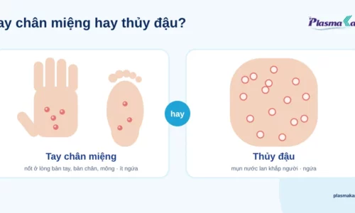 Minh hoạ phẳng so sánh nốt ở lòng bàn tay, bàn chân của tay chân miệng với mụn nước lan khắp thân của thủy đậu