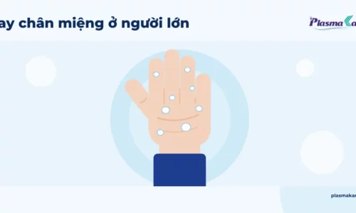 Minh họa phẳng bàn tay người lớn xòe ra với vài nốt phỏng nước nhỏ ở lòng bàn tay, nền xanh nhạt