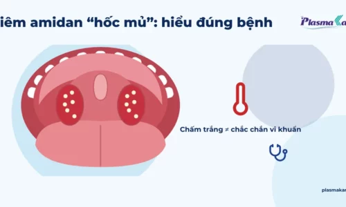 Minh họa khoang họng nhìn từ miệng mở, hai amidan sưng đỏ có chấm trắng trên bề mặt